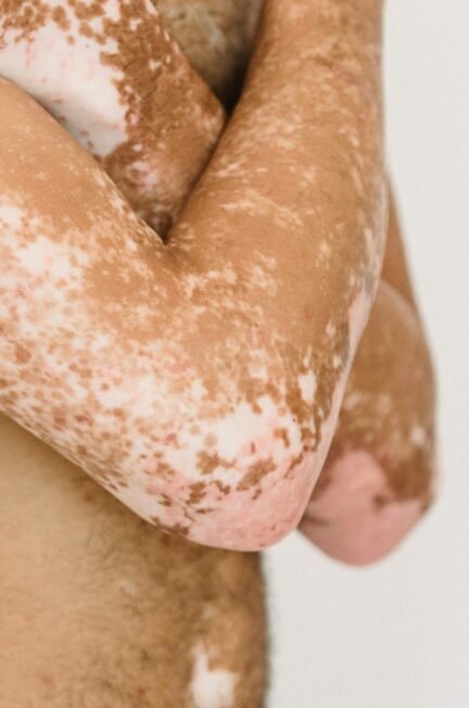 maladies dermatologiques / Crop unrecognizable shirtless male with vitiligo skin patches crossing arms on bare chest in light studio