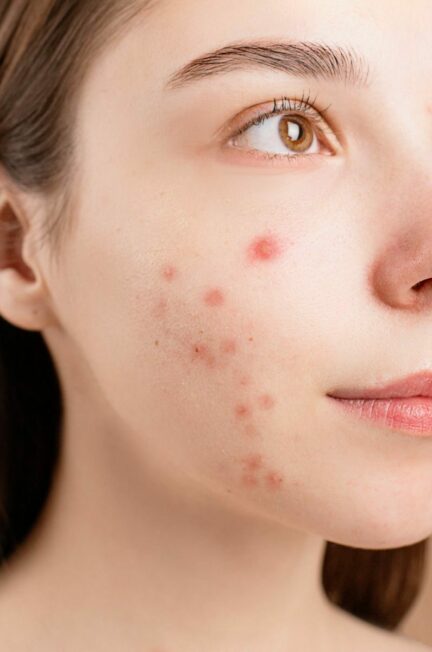 Maladie de Verneuil - A detailed close-up of a woman's face showing acne blemishes on her skin.